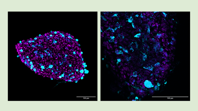 Microscopic images of tumor cells