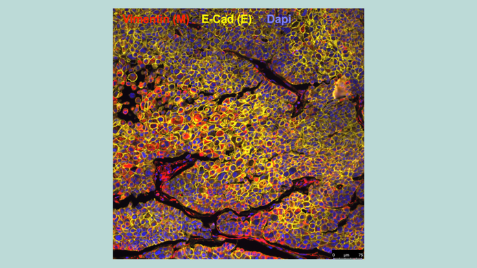 Microscopic image of heterogeneous cancer tissue. The colors show the different states of the cells: vimentin, which is typical for mesenchymal cells (M), is shown in red; E-cadherin, which is typical for epithelial cells, in yellow, and cell nuclei in blue. 