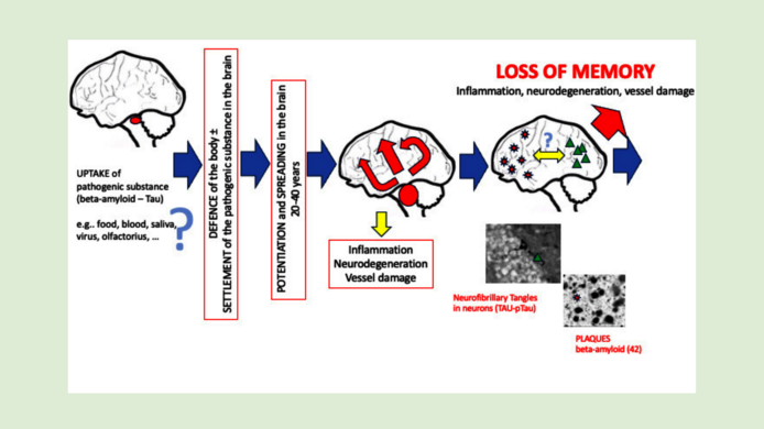 Graphic showing the gradual development of Alzheimer's disease through plaques and nerve cell death to memory loss
