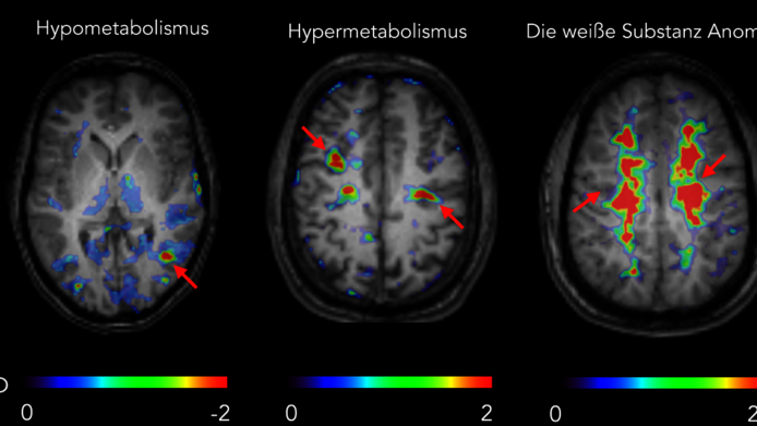 Die Abbildung zeigt Hirnscans von hypometabolischen, hypermetabolischen und bilateralen abnormalen Zonen, die mit dem entsprechenden MR-Bild überlagert sind.