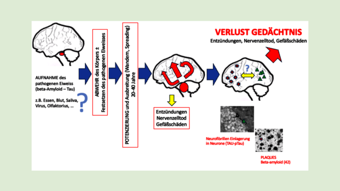 Grafik zur schrittweisen Entwicklung von Alzheimer durch Plaques und Nervenzelltod bis zum Verlust des Gedächtnisses