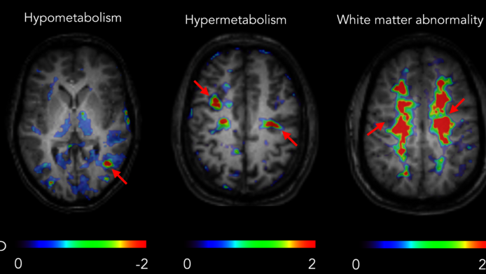 The image shows brain scans of hypometabolic, hypermetabolic and bilateral abnormal zones overlaid with a corresponding MR image.