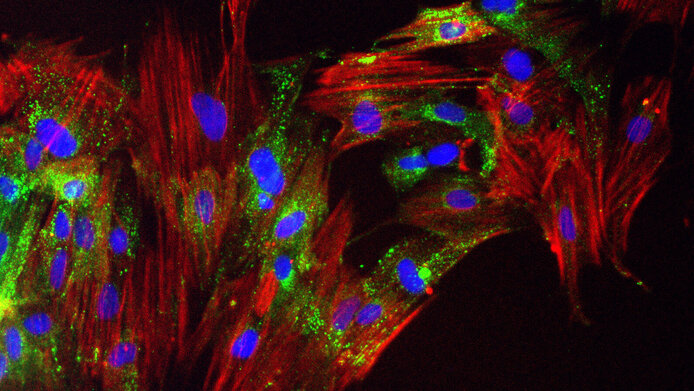 Mikroskopische Aufnahmen einer Kultur von krebsassoziierten Fibroblasten aus der Biobank. Rechts wurden krebsassoziierte Fibroblasten im späten Aktivierungsstadium mit Fluoreszenzstoffen markiert (grün: Zellinneres, blau: Zellkerne, rot: Teile des Zytoskeletts). 