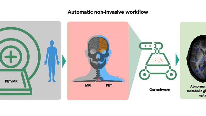 Graphic showing the workflow of automatic non-invasive method to determine the brain's sugar metabolism.